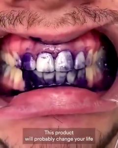 hismile toothpaste my smile teeth whitening toothpaste v34 toothpaste colour corrector tiktok hot sale v34 牙膏 gigi putih ubat gigi pemutih pemutih gigi kuning