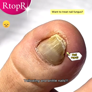 RtopR Ginger Antibacterial Nail Treatment Essential Oil Treatment Onychomycosis Paronychia Anti Fungal Nail Infection Toe Nail Nursing 10ml