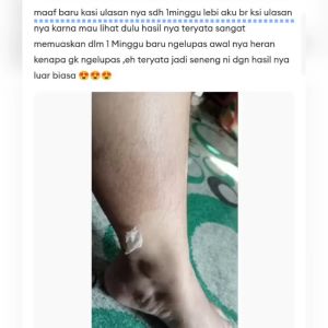 Peeling TCA 25% free kuas