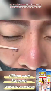 Authentic Japan Wart Removal Cream Wart Remover Ointment 20g Milia Syringomas Facial Warts And Any Skin Hyperplasia Warts Corns Remover Safe And Painless Wart Removal.