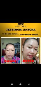 ANZORA PAKET ACNE DARK SPOT