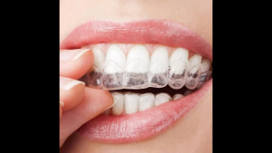 🇲🇾Invisible Mouth Guard for Grinding Teeth Bruxism Sleep Aid Mouthpiece Stop Teeth Grinding Clenching Sleep Aid 磨牙牙套 Fit