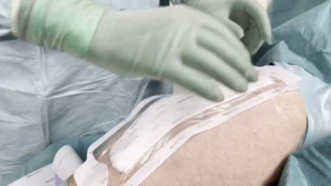 Mepilex Border Post-Op แผ่นปิดแผล ชนิดซิลิโคนนิ่ม แบบมีกาวในตัว กันน้ำ (1 แผ่น)