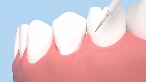 Teeth Cleaner Tartar Ultrasonic Tooth Cleaner Machine Teeth Whitening and Tartar Remover Dental Scaler for Teeth Usb Electric Tooth Brush Electric Ultrasonic Toothbrushes for Adult