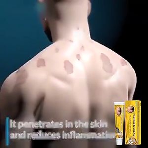 South Moon Psoriasis Cream Eczema Treatment Ointment for Effective Treatment Itchy Skin and Allergy Eczema Antifungal Infection Safe Herbal Formula Does Not Harm the Skin