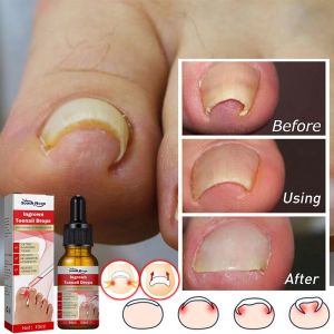 ubat kuku rosak ingrown toenail nail fungus treatment甲沟炎嵌甲灰指甲ubat kuku cekam toenail corrector paronychia pain relief