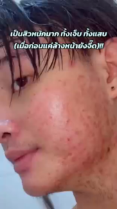 MOPLAI Salicylic Acid Acne เซรั่มสิวอ่อนโยน 10ml ลดรอยแดงไม่ระคายเคือง เหมาะผิวแพ้ง่าย+สิวผด