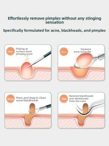 CMGF | Acne Removal Tool Set