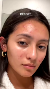 เกรดทางการแพทย์ : MENOE Soft Laser High Frequency+ เครื่องเลเซอร์ฆ่าเชื้อสิว แบบพกพาสำหรับรักษาสิวกระชับผิวลดริ้วรอย