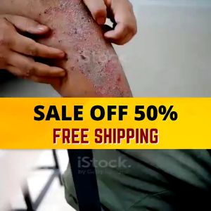 HERBAL ANTI-BACTERIA CREAM Antibacterial Pslergiesoriasis Cream Dermatitis Eczema Treat Ointment 30g