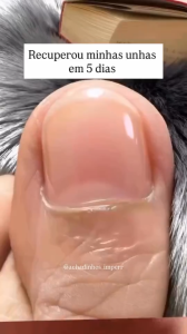 【BUY 1 TAKE 1】21 Patches/Pack. Nail Repair Patches Toenail Fungus Patches Adhesive Toenail Care Ingrown Toenail Correction Patches Disposable Toenail Patches For Paronychia Repairs And Nourishes Damaged Toenails.