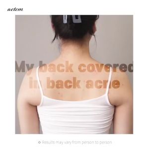 Acne body wash  Body Wash  Wormwood Body Mites remove shower gel  500ml  Bacteriostatic itching For Dry Acne Itchy Skin Care Cleans skin removes dirt