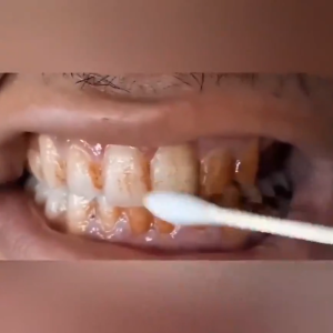 KADAIE EELHOE: Pembersih Plak Gigi & Pemutih Gigi Kuning