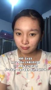 WARDAH Acnederm Acne Care Serum 15ml: Perawatan Kulit Berminyak & Jerawat