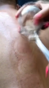 Bộ Dụng Cụ Giác Hơi 12 Ly Không Dùng Lửa Tiện Dụng