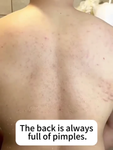 Sulfur mite-removing shower gel Acne body wash eczema body wash 500ml Mite-removing Antibacterial Anti-itching Oil control Deep skin cleansing