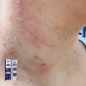 Ouhoe Wart Remover Ointment Remover Extract Corn Plaster Wart Ointment Remover Mole And Warts Remover Warts Flat Warts 20g