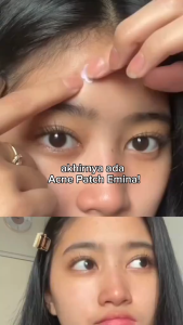 RUMAH CANTIK Emina Ms. Pimple Acne Patch 12 Pcs & 15 Pcs | Pimple Pacth Acne Spot Treatment Sticker Jerawat Tipis Penghilang Jerawat dengan Centella Asiatica Tea Tree dan Chamomile
