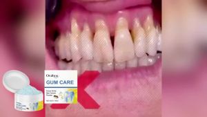 oralhoe | Oralhoe Bee Venom Tooth Powder Remove Tooth Stains Deep Teeth Cleaning Fresh Breath Dental Care Products Teeth Whitening Powder