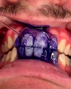 SG STOCK!!Teeth Whitening V34 Colour Corrector My Smile Toothpaste Original Purple Toothpaste Tartar Remover Tooth Stain