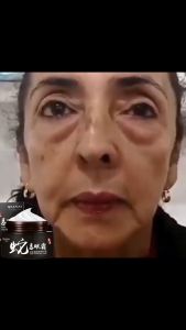 Menghilangkan Lingkaran Hitam Mata & Bengkak dengan Krim Mata Anti Penuaan