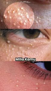 Alami Perawatan Kulit Beruntusan dengan Krim Anti Jerawat & Anti Komedo