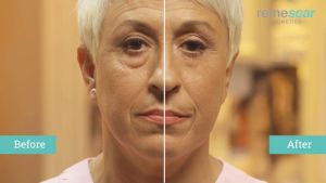 (Bundle of 2) REMESCAR Eye Bag and Dark Circles 8ml