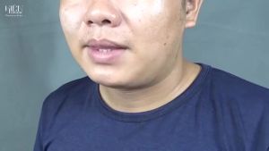 Máy Hút Mụn Mini Cầm Tay Siêu Mạnh Anphaltech Có Chức Năng Làm Nóng- Hút Mụn Đầu Đen Mụn Cám Làm Sạch Bã Nhờn