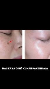 HYALURA Glow and Bright Serum - Mampu Menyamarkan Noda Hitam & Meratakan Warna Kulit Wajah