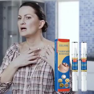 EELHOE Wart Remover Pen Krim Penghilang Lalat Krim Penghilang Kutil Mudah Dibawa Untuk Semua Kulit Krim Penghilang KutilWart Removal Cream