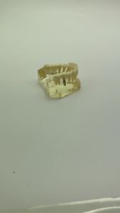 Dental implant fixtures teeth Implant Typodont Lower Jaw Bridge Model dentistry teaching model