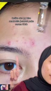 Serum Originote Acne B5: Solusi Anti Jerawat & Anti Inflamasi