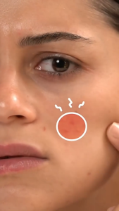 แผ่นแปะสิว 200 แผ่น แผ่นแปะสิวดาว สีผสม สติ๊กเกอร์สิว สติ๊กเกอร์ปิดสิวชนิดบรรจุกล่อง Acne Patch