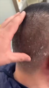 [ COMBO 3 TUÝP SIÊU GIẢM GIÁ ] Gel Ngăn Ngừa Nấm Ngứa Giảm Gàu Làm Sạch Sâu Da Đầu Hiệu Quả Và An Toàn Chống Gàu Giúp Sạch Da Đầu