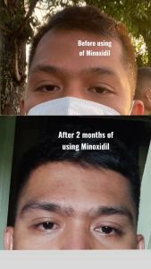 No. 1 Top Selling Minoxidil Strands ( 60ml per bottle ) with 6% Topical Solution for Scalp and Hair Growth Treatment for Hairloss Hair Thinning Damaged Hair Anti Baldness Anti Hair loss Good for Hydrating Volumizing Stimulating Hair Follicles