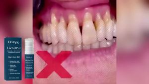 oralhoe | Gum Care Gel Repair Gum Tissue Enhance Gum Resistance Prevent Gum Atrophy Relieve Gum Sensitivity And Pain Daily Oral Care