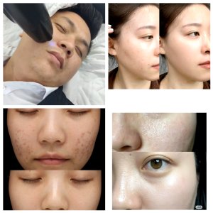 Morpheus8 Fractional Beauty Device 2 in1 Micro RF Radiofrecuent Skin Tightening Wrinkle Scar Removal Microneedling RF Face Morpheus 8