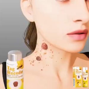 Buang tahi lalat dan kutil Biji kolestrol remover wart removal Spray