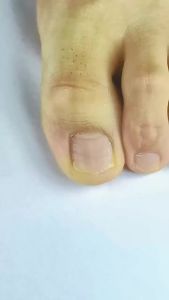 Professional Ingrown Toenail Corrector Tool for Embedded Nail Treatment And Foot Care Recovery Instrument