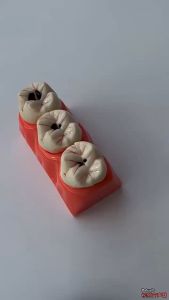Caries Dental Mode 4X  Model Study Anatomi Gigi Caries  Model Karies