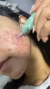 Obat Penghilang Jerawat Totol Reglow Acne Gel Penghilang Jerawat Bruntusan dan Bekas Jerawat