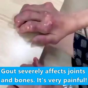 Kem Chăm Sóc Xương Khớp Giảm Sưng Đau Gout và Xẹp Tophi Thảo Dược gút