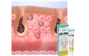 cream penghilang flek hitam salep melasma flek hitam membandel 20g cream flek dan kusam bpom/Remove Dark Spots Bintik