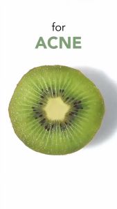 Glad2Glow Kiwi 3D Acid Acne Moisturizer 30 Gr