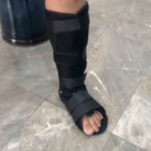 เฝือกอ่อนขา น่องขา ข้อเท้า เฝือกอ่อน หลังจากผ่าตัด ผ่าตัด บันเทาอาการเจ็บปวด น่อง ขา ฝ่าเท้า  และ รองเท้าหุ้มเฝือก ช่วยให้เดินได้สะดวก by.PRIMA