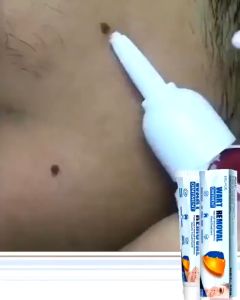 Krim Penghilang Kutil & Tahi Lalat Efektif untuk Penghilang Kutil Wajah dan Mata Ikan 20g