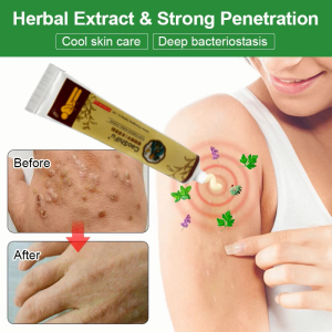 Psoriasis Cream Skin Care Cream Dermatitis Eczematoid Eczema Ointment Treatment 20g