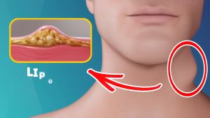 脂肪瘤去除霜Lipoma removal cream with natural plant additives for gentle elimination of lipomas 20g to reduce lumps and lymph nodes