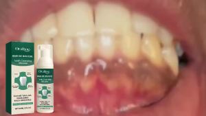 oralhoe | Rapid Repair Gums Mousse Effectively Relieve Tooth Allergy Dental Caries Tooth Cleaning Toothpaste Relieve Tooth Damage Drops