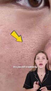 LANBENA | LANBENA Blackhead Removing Nose Strips and Pore Minimizing Serum Set Nose Mask